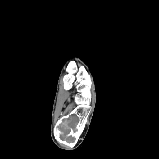 File:Aneurysmal bone cyst of the calcaneus (Radiopaedia 60669-68421 A 30).jpg