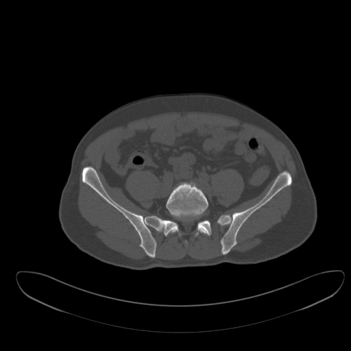 Ankylosing spondylitis (Radiopaedia 52728-58645 Axial bone window 3).jpg