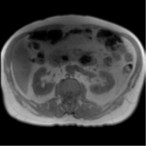 File:Annular pancreas (Radiopaedia 38292-40320 Axial T1 IN-OPP 44).png
