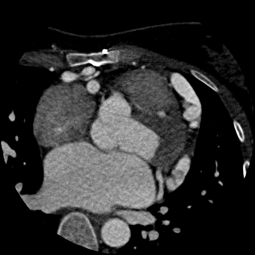 File:Anomalous left coronary artery from the pulmonary artery (ALCAPA) (Radiopaedia 40884-43586 A 30).jpg