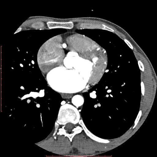 File:Anomalous left coronary artery from the pulmonary artery (ALCAPA) (Radiopaedia 70148-80181 A 167).jpg