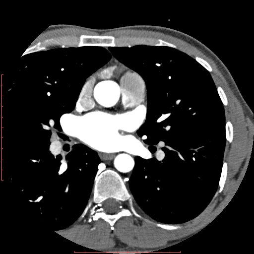 Anomalous left coronary artery from the pulmonary artery (ALCAPA) (Radiopaedia 70148-80181 A 67).jpg