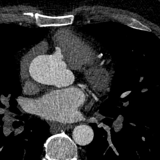 File:Anomalous origin of the left coronary artery with malignant course (Radiopaedia 77842-90126 C 50).jpeg