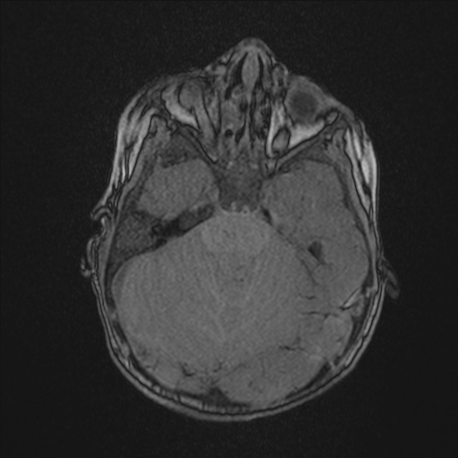 Anoxic brain injury (Radiopaedia 79165-92139 Axial MRA 66).jpg