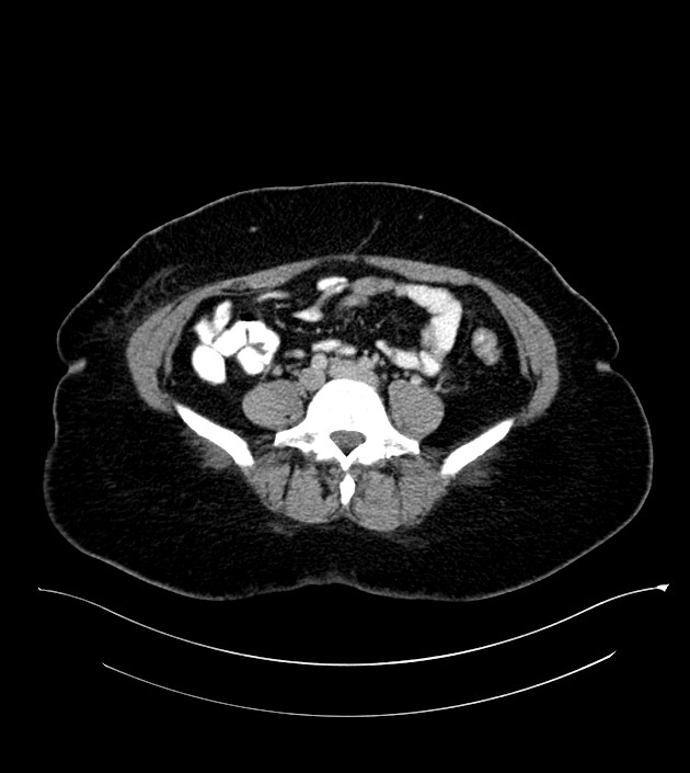 Anterior abdominal wall CSF pseudocyst (CSFoma) (Radiopaedia 79453-92571 A 61).jpg