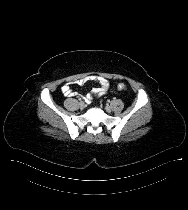 Anterior abdominal wall CSF pseudocyst (CSFoma) (Radiopaedia 79453-92571 A 68).jpg