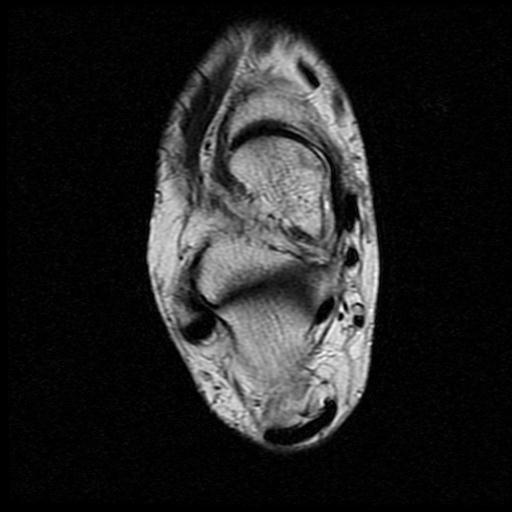 File:Anterior calcaneal process fracture (Radiopaedia 71377-81705 Axial T2 9).jpg
