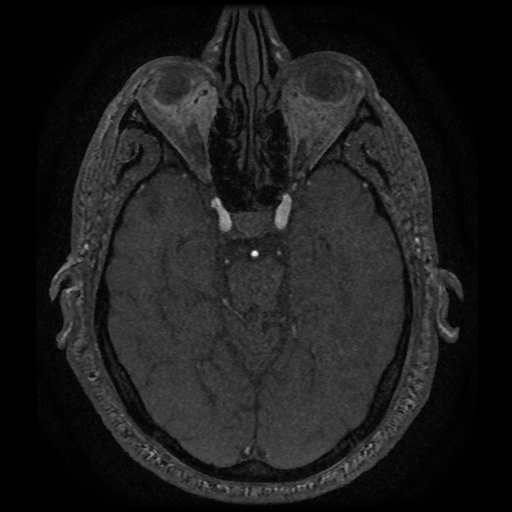 Anterior cerebral artery infarction (Radiopaedia 46794-51323 Axial MRA 63).jpg
