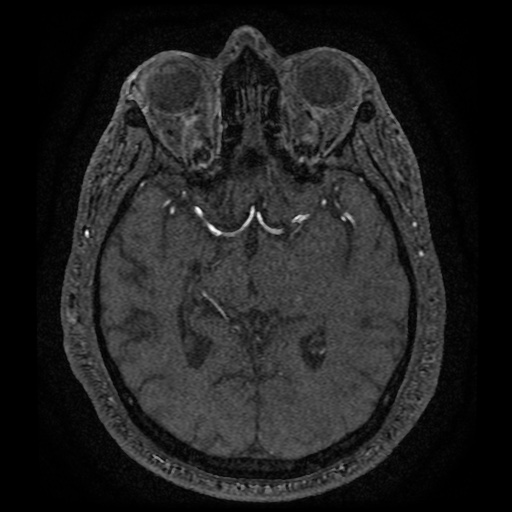 Anterior cerebral artery infarction (Radiopaedia 46794-51323 Axial MRA 92).jpg