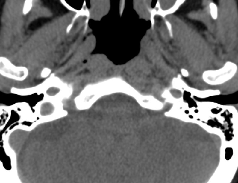 Anterior cervical postdiscectomy arthrodesis (Radiopaedia 32678-33646 Axial non-contrast 2).jpg