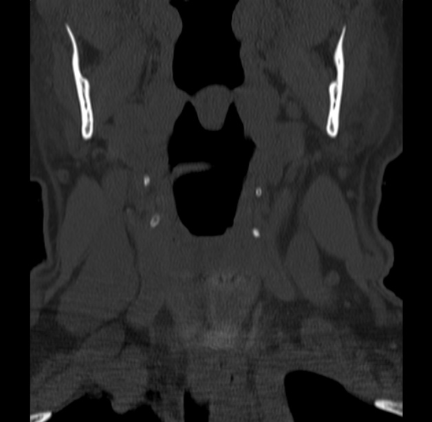 Anterior cervical postdiscectomy arthrodesis (Radiopaedia 32678-33646 Coronal bone window 4).jpg
