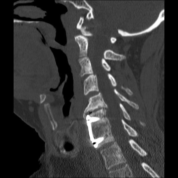 Anterior cervical postdiscectomy arthrodesis (Radiopaedia 32678-33646 Sagittal bone window 45).jpg