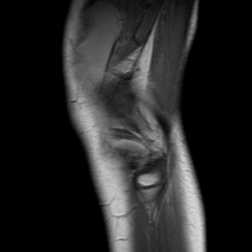 File:Anterior cruciate ligament avulsion fracture (Radiopaedia 24710-24974 Sagittal T1 12).jpg