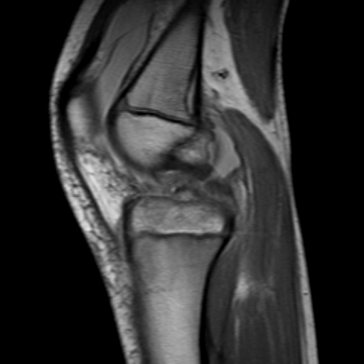 File:Anterior cruciate ligament avulsion fracture (Radiopaedia 24710-24974 Sagittal T1 5).jpg