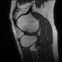 File:Anterior cruciate ligament rupture and posteromedial corner injury (Radiopaedia 67338-76723 Sagittal PD 129).jpg
