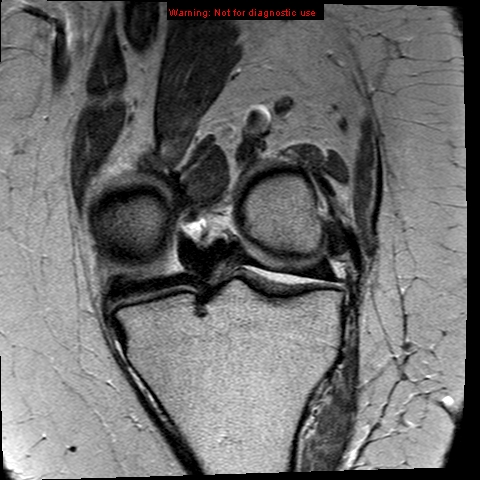 File:Anterior cruciate ligament tear (Radiopaedia 12329-12612 C 12).jpg