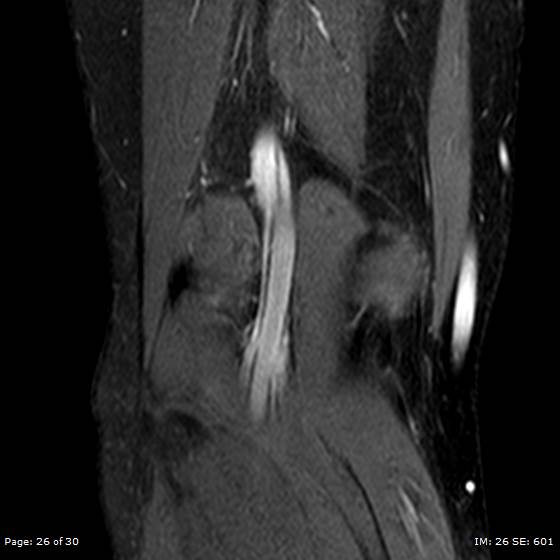 File:Anterior cruciate ligament tear (Radiopaedia 70783-80964 Coronal STIR 26).jpg
