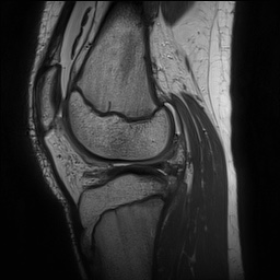 File:Anterior cruciate ligament tear - pediatric (Radiopaedia 62152-70260 Sagittal PD 110).jpg