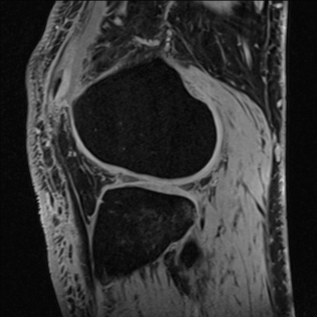 Anterior cruciate ligament tear - ramp lesion (Radiopaedia 71883-82322 Sagittal T1 vibe 42).jpg