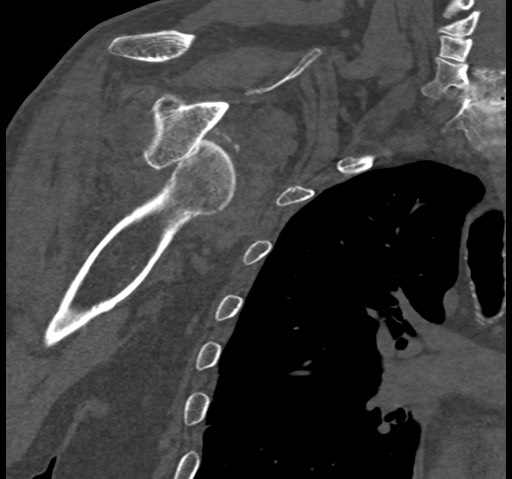 Anterior glenohumeral dislocation with Hill-Sachs lesion (Radiopaedia 62877-71249 Coronal bone window 56).jpg