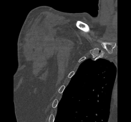 Anterior glenohumeral dislocation with Hill-Sachs lesion (Radiopaedia 62877-71249 Coronal bone window 6).jpg