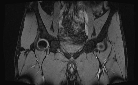 Anterior inferior iliac spine avulsion fracture (Radiopaedia 81312-95000 G 66).jpg