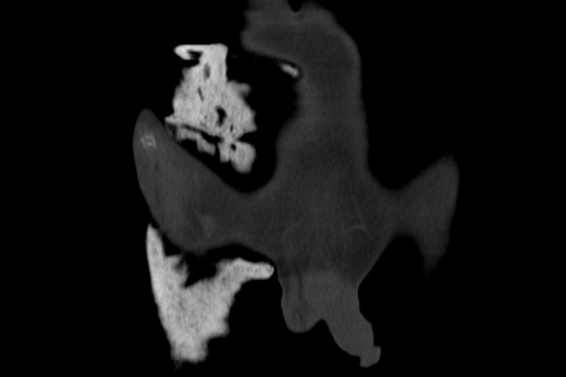 Anterior inferior iliac spine avulsion injury (Radiopaedia 88666-105376 Coronal bone window 9).jpg