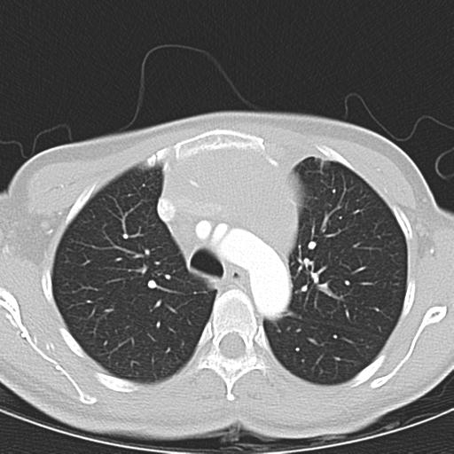 Anterior mediastinal lymphoma (Radiopaedia 29556-30061 Axial lung window 16).jpg