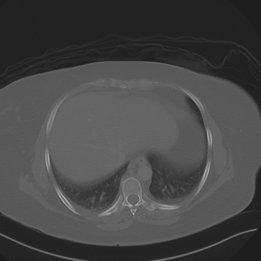 Anterior superior iliac spine avulsion fracture (Radiopaedia 44541-48244 Axial bone window 11).png