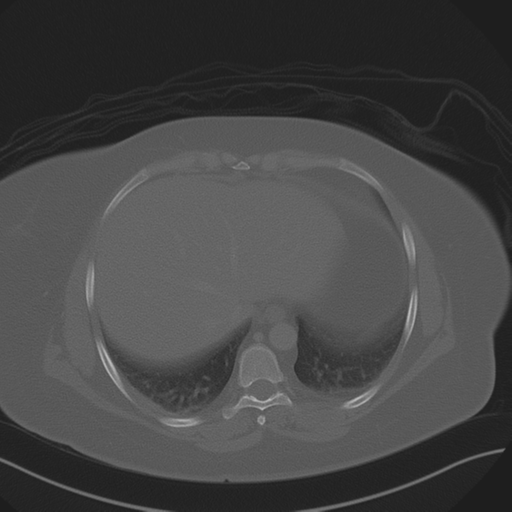 Anterior superior iliac spine avulsion fracture (Radiopaedia 44541-48244 Axial bone window 13).png