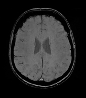 File:Anterior temporal lobe perivascular space (Radiopaedia 40946-43650 Axial SWI 56).png