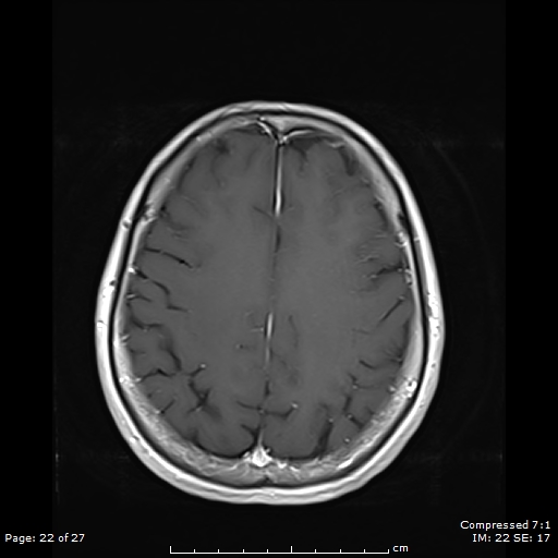File:Anterior temporal lobe perivascular space (Radiopaedia 88283-104914 Axial T1 C+ 22).jpg