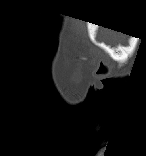 Anterior temporomandibular joint dislocation (Radiopaedia 59430-66784 B 1).jpg