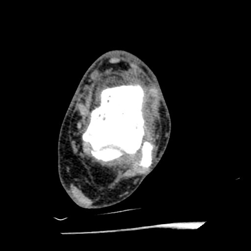 Anterior tibial artery false aneurysm (Radiopaedia 88984-105809 A 144).jpg