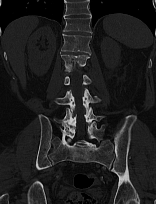 Anterior vertebral scalloping (abdominal aortic aneurysm) (Radiopaedia 66744-76067 Coronal bone window 47).jpg