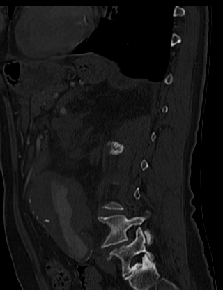 File:Anterior vertebral scalloping (abdominal aortic aneurysm) (Radiopaedia 66744-76067 Sagittal bone window 66).jpg