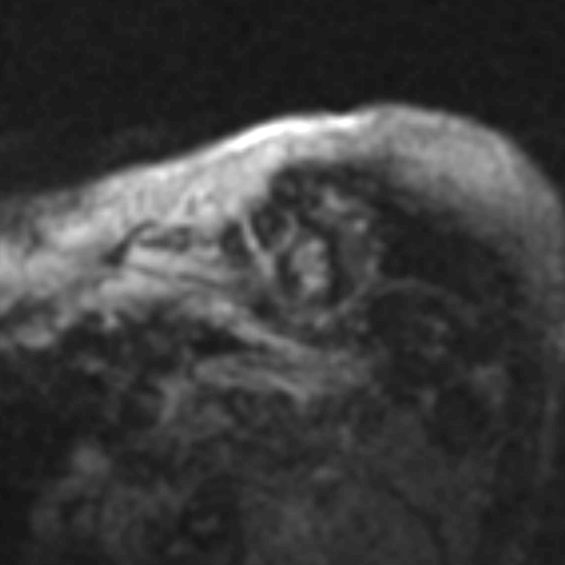 File:Anteroseptal hypokinesia after myocardial infarction (Radiopaedia 15978-15633 I 8).jpg