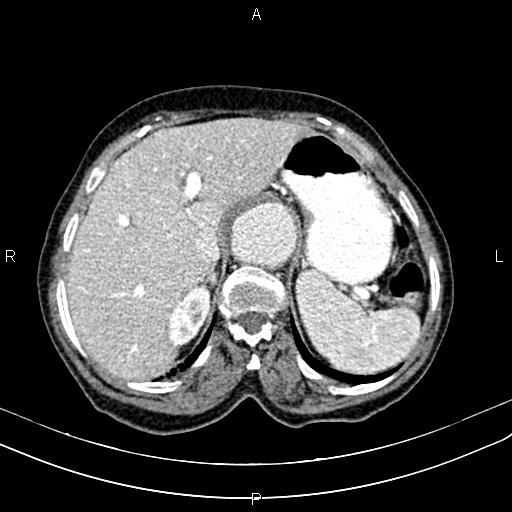 File:Aortic aneurysm and Lemmel syndrome (Radiopaedia 86499-102554 A 20).jpg