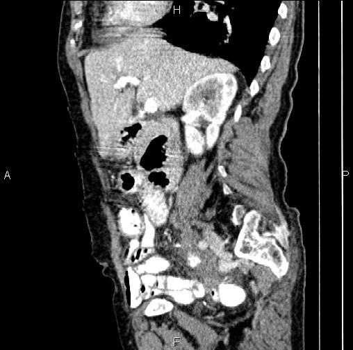 Aortic aneurysm and Lemmel syndrome (Radiopaedia 86499-102554 D 32).jpg