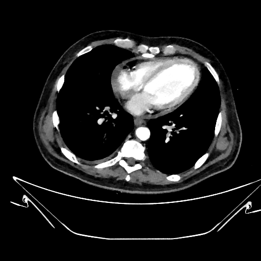 Aortic arch aneurysm (Radiopaedia 84109-99365 C 305).jpg