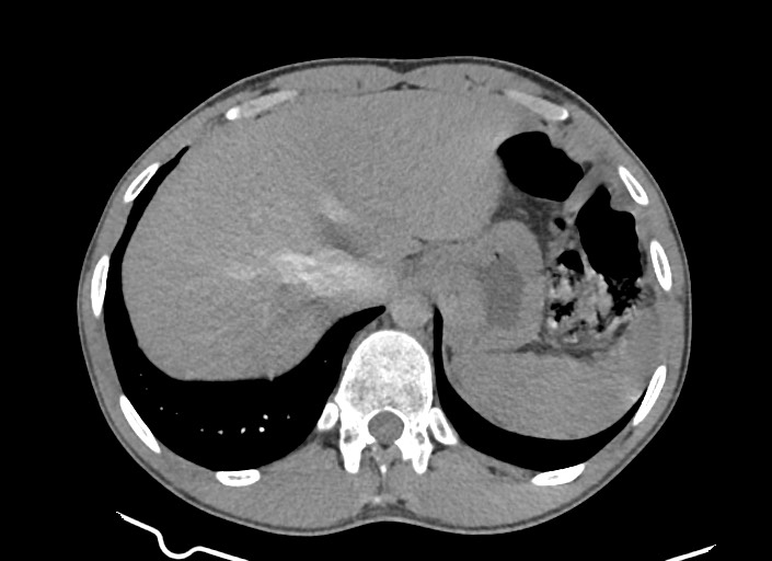 File:Aortic coarctation with aneurysm (Radiopaedia 74818-85828 A 41).jpg