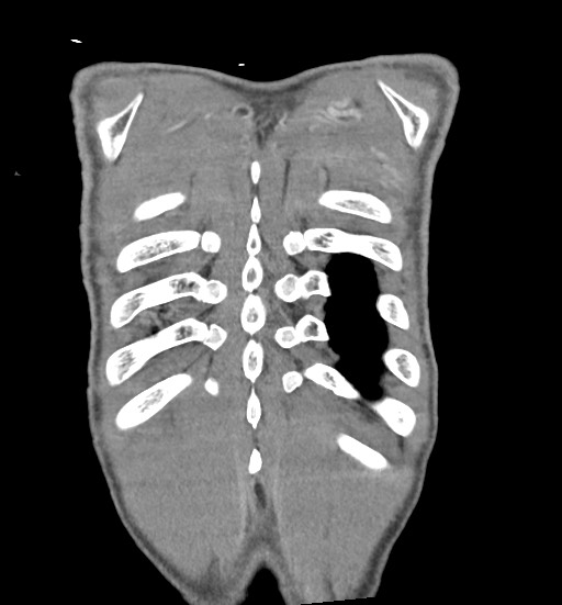 Aortic coarctation with aneurysm (Radiopaedia 74818-85828 C 110).jpg