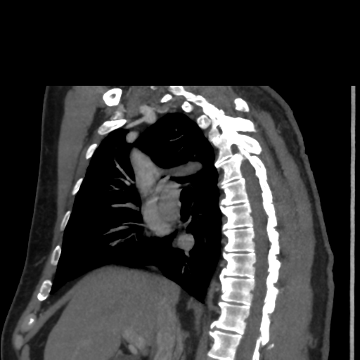 File:Aortic dissection- Stanford A (Radiopaedia 37759-39664 D 6).png