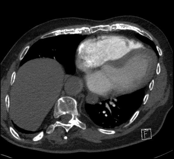 File:Aortic dissection (CTPA) (Radiopaedia 75506-86751 Axial C+ CTPA 95).jpg
