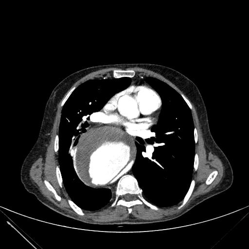 Aortic dissection (Radiopaedia 27466-27665 C+ arterial phase 134).jpg