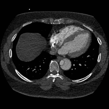 File:Aortic dissection (Radiopaedia 57969-64959 A 209).jpg