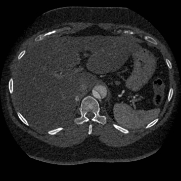 Aortic dissection (Radiopaedia 57969-64959 A 303).jpg