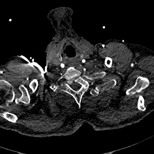Aortic dissection - DeBakey type II (Radiopaedia 64302-73082 A 4).png