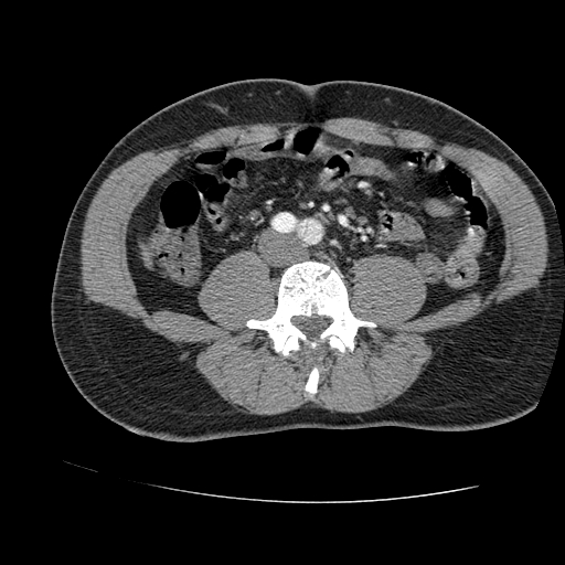 File:Aortic dissection - Stanford A -DeBakey I (Radiopaedia 28339-28587 B 158).jpg