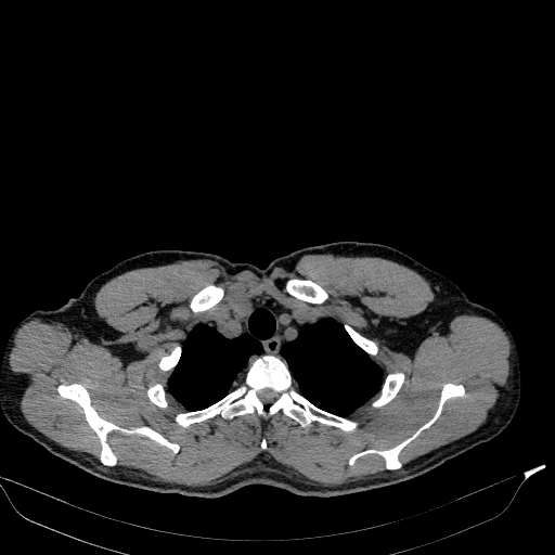 File:Aortic dissection - Stanford type A (Radiopaedia 83418-98500 Axial non-contrast 4).jpg
